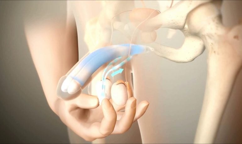 penile Prothesis