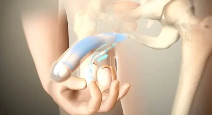 Penis Protezi